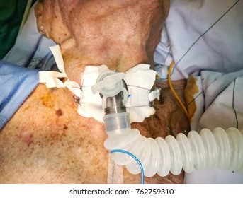 Old age man with sepsis after tracheostomy operation for safe life