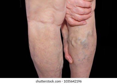 The Old Age And Sick Of A Woman. Varicose Veins On A Legs Of Old Woman On Blue. The Varicosity, Spider Veins, Edema, Illness Concept. Senior Pensioner Woman With Hands On Legs. Black Studio Background