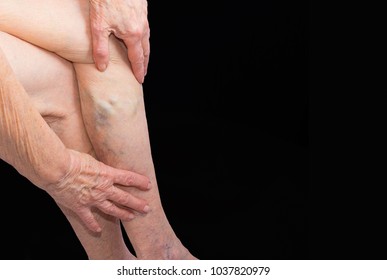 The Old Age And Sick Of A Woman. Varicose Veins On A Legs Of Old Woman On Blue. The Varicosity, Spider Veins, Edema, Illness Concept. Senior Pensioner Woman With Hands On Legs. Black Studio Background