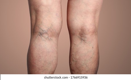The old age and sick of a woman. Varicose veins on a legs of woman. The varicosity, spider veins, edema, illness concept.
