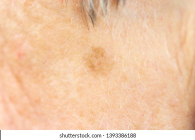 Melanosis Bilder Stockfoton Och Vektorer Med Shutterstock