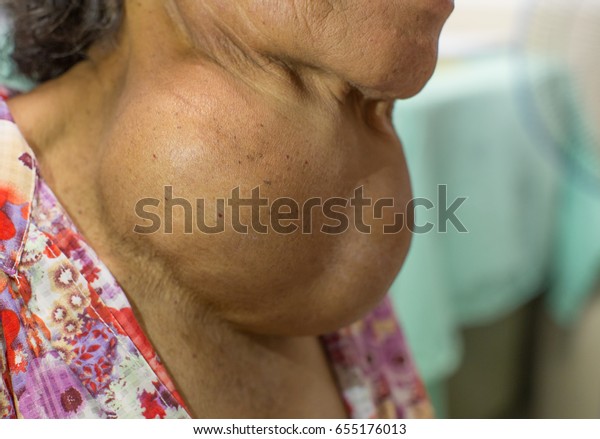 亚洲老女性甲状腺肿大非常大的缩放特写侧视图库存照片 立即编辑