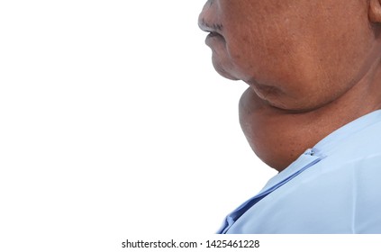 Old Asian male with very large thyroid gland enlargement in zooming closeup lateral view on white background.Medical image concept