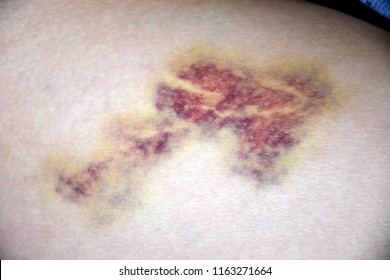 Old Bruise On The Skin, Bruising, Soft Tissue Injury.