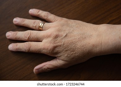 Old Female Hands Full Of Freckles And Wrinkles. Aging Concept