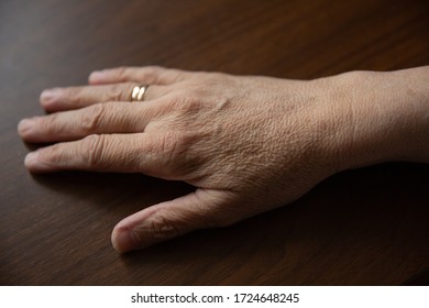 Old Female Hands Full Of Freckles And Wrinkles. Aging Concept