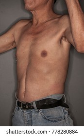 Old Man Body Operation Scar On Stock Photo (Edit Now) 778280884