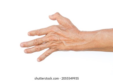 An Old Man Left Hand Muscle Atrophy Between A Thumb And Index Finger 