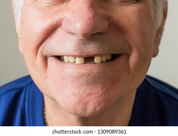 Old Man Senior Face Closeup Missing Tooth Smile Proper Care Dental Plan Hygiene