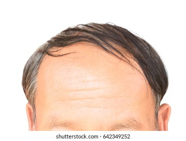 Old Man Serious Hair Loss Problem For Health Care Shampoo And Beauty Product Concept