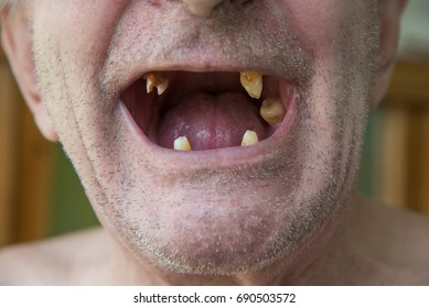 Men with bad teeth