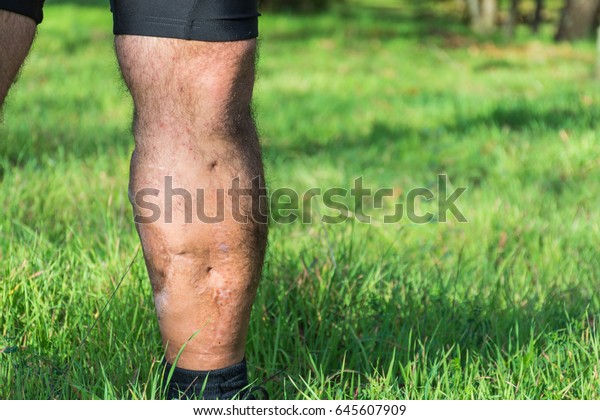 Old scar of leg injury, from car or motorbike\
accident, deep tissue scar , hairless man leg, calf injury , large\
scar on right hand calf. The scars as wounds, leave a mark on the\
skin. Work accident.