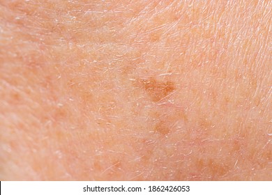 Old Spot Of Lentigo On The Skin Of A Man Macro Photo. Skin Pigmentation With Age, Pigment Spots, Skin Aging