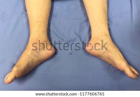 Old woman foots swellings Lay down on bed. In the Hospital.