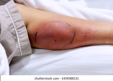 Old woman get injured from a horse kick her leg. Calf leg of person have mark the prepare for surgery. because of the inflammation is located within.
