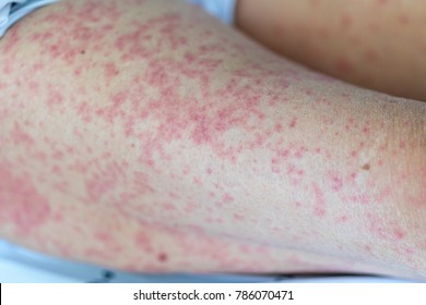 Drug Rash Images Stock Photos Vectors Shutterstock