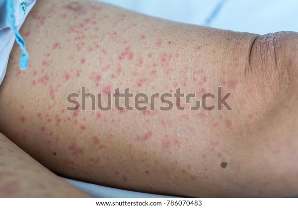 Skin Rashes Due To Drug Allergy Update Berita Olahraga Dalam Luar