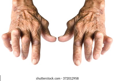 Old Woman's Hands Deformed From Rheumatoid Arthritis Isolated on White Background