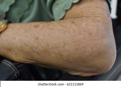 Old Women Skin Arm Wither