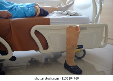 The older with prosthetic leg sleep on bed in hospital. Selective focus. - Powered by Shutterstock