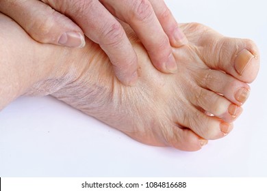 An Older Woman Has Itchy And Dry Skin On Her Hands And Feet
