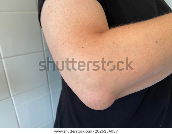 olecranon bursitis is sometimes called “Popeye’s\
elbow.” Bursitis is a swelling of the bursitis sac here on elbow\
also known as tennis\
elbow