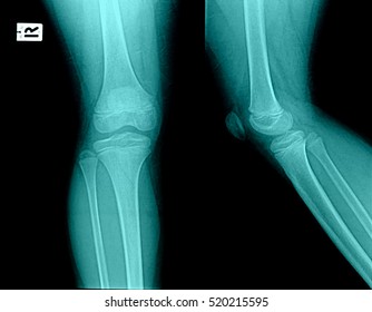 Ollection Xray Normal Knee Stock Photo (edit Now) 520215595