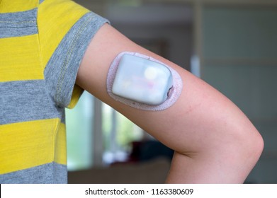 An Omnipod Diabetes Management Insulin Pump On A Girls Arm