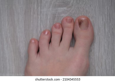 On The Big Toe Of A Woman There Is A Brown Hematoma. After Hitting A Foot Or Uncomfortable Shoes, A Bruise Appeared On The Big Toe.