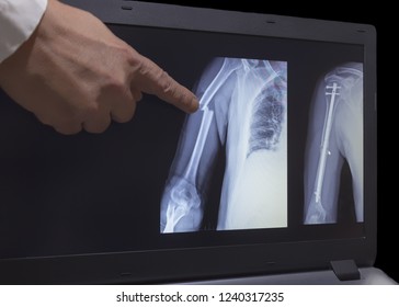 On the monitor screen is displayed an xray of fracture of a hand with the hand of a doctor pointing to a fracture. The second image on the screen is hand after operation with titanium screws.
