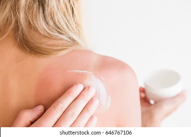 On Woman's Back Skin Smears Cream After Sun Burn.  