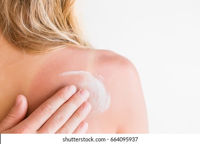 On Woman's Back Skin Smears Cream After Sun Burn. 