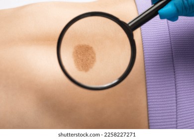 On the woman's stomach, the doctor examines the problem area of the skin with a large mole. - Shutterstock ID 2258227271