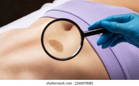 On the woman's stomach, the doctor examines the problem area of the skin with a large mole. - Shutterstock ID 2260070085