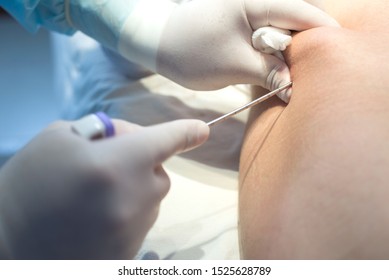 An Oncologist, Using A Long Needle, Pierces A Childs Ilium To Diagnose Bone Marrow For Leukemia, Ewings Sarcoma