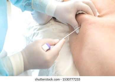 An Oncologist, Using A Long Needle, Pierces A Childs Ilium To Diagnose Bone Marrow For Leukemia, Ewings Sarcoma