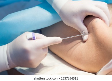 An Oncologist, Using A Long Needle, Pierces A Childs Ilium To Diagnose Bone Marrow For Leukemia, Ewings Sarcoma