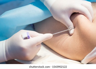 An Oncologist, Using A Long Needle, Pierces A Childs Ilium To Diagnose Bone Marrow For Leukemia, Ewings Sarcoma