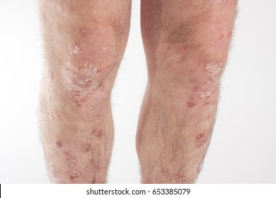 One Caucasian Male With Psoriasis, Eczema, Atopic Dermatitis On The Skin On A Light Background