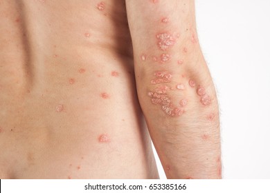 One Caucasian Male With Psoriasis, Eczema, Atopic Dermatitis On The Skin On A Light Background