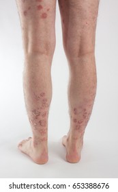 People Suffering Varicose Veins Often Come Stock Photo (Edit Now ...