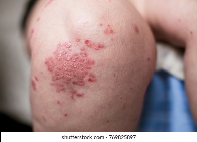 One Caucasian Woman With Psoriasis, Eczema, Atopic Dermatitis On The Skin Of Leg. Skin Rashes From Contact Allergic Reaction