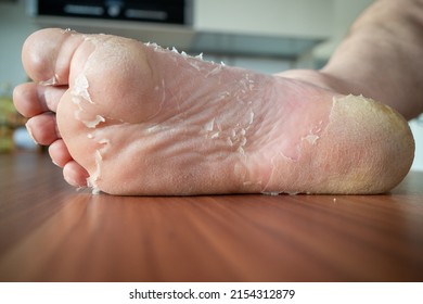 From One Foot The Skin Peels Off 