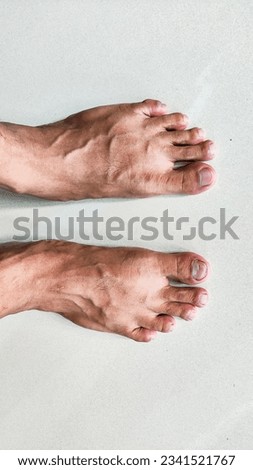 one form of worker's foot