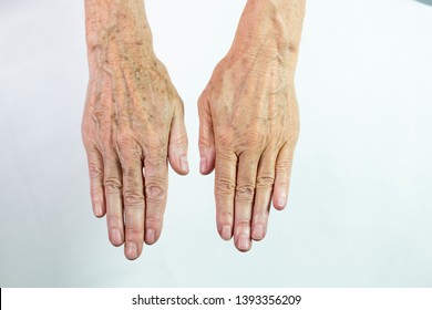 Eine Hand mit Flecken im Alter und die andere mit Laser behandelte