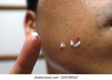 One Man Has A Red Pimple On His Cheek.