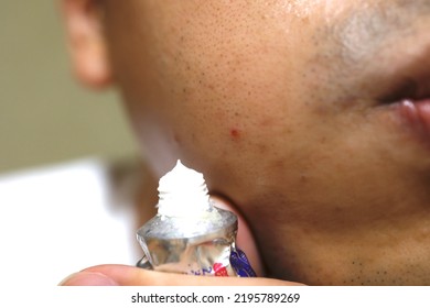 One Man Has A Red Pimple On His Cheek.