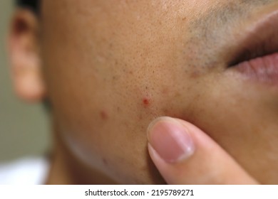 One Man Has A Red Pimple On His Cheek.