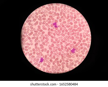 One Monocyte And Two Lymphocytes In Blood Smear. Red Blood Cell.