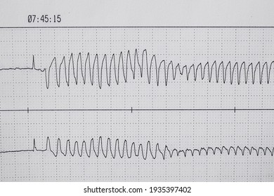 Onset Of A Ventricular Tachycardia